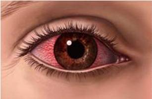 conjuntivitis lentes de contacto